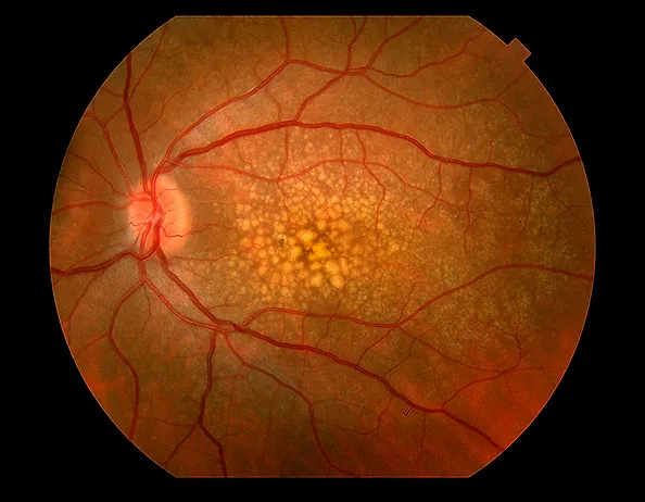 Photo d'un œil atteint de dégénérescence maculaire liée à l'âge, montrant une tache floue dans la vision centrale.